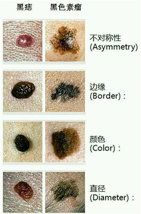 黑痣癌变早期|点痣不正规可能引发癌变：关于痣的 4 个常识